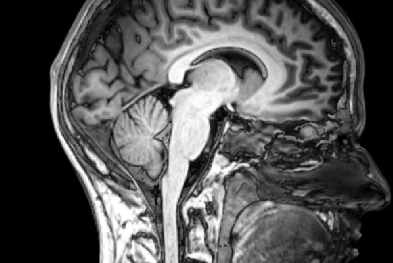 enhanced brain image data